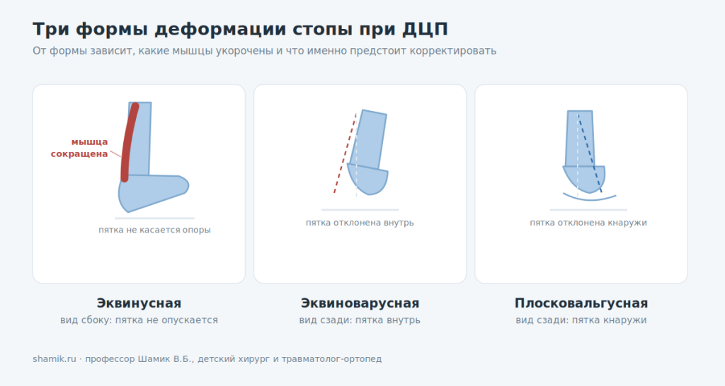 Три формы деформации стопы при ДЦП: эквинусная, эквиноварусная, плосковальгусная