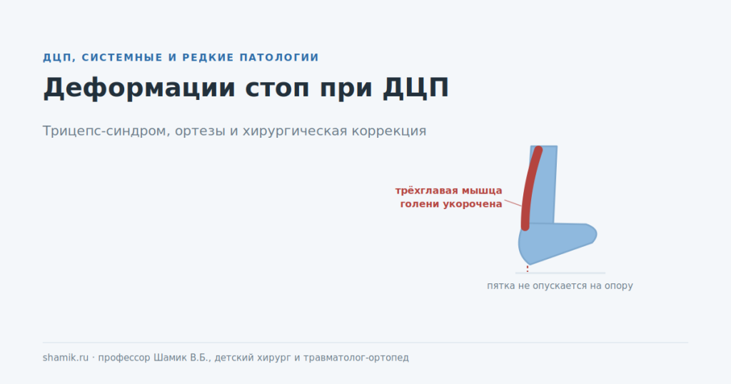 Деформации стоп при ДЦП: укороченная трёхглавая мышца голени и эквинусное положение стопы