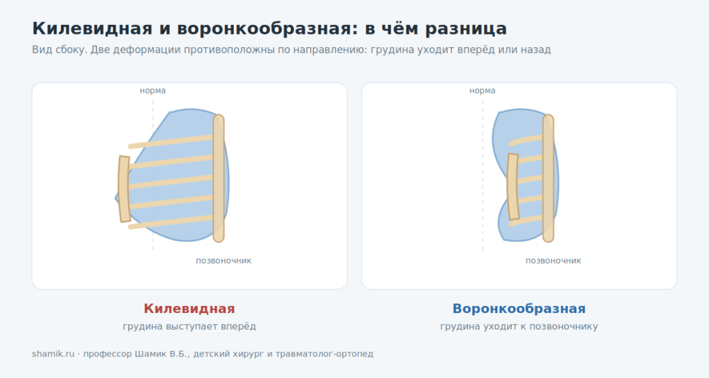 Разница между килевидной и воронкообразной деформацией грудной клетки, вид сбоку