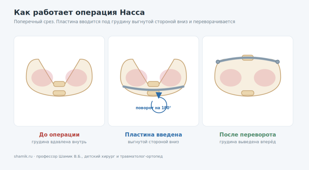 Механизм операции Насса: пластина вводится выгнутой стороной вниз и переворачивается на 180 градусов