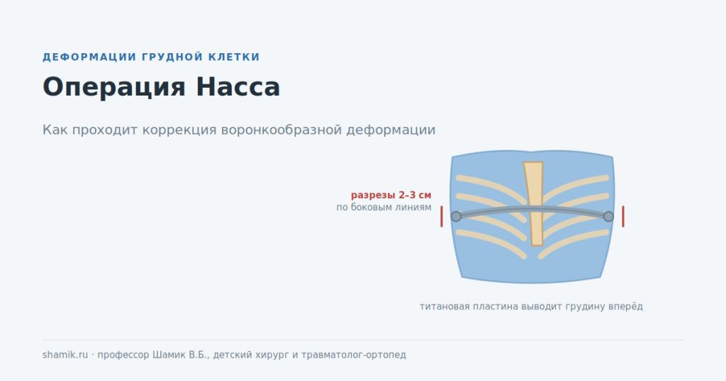 Операция Насса: титановая пластина под грудиной и разрезы по боковым линиям груди