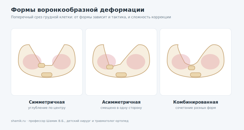 Формы воронкообразной деформации грудной клетки: симметричная, асимметричная, комбинированная