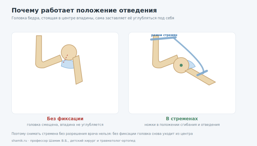 Механизм действия стремян Павлика: положение отведения центрирует головку бедра во впадине