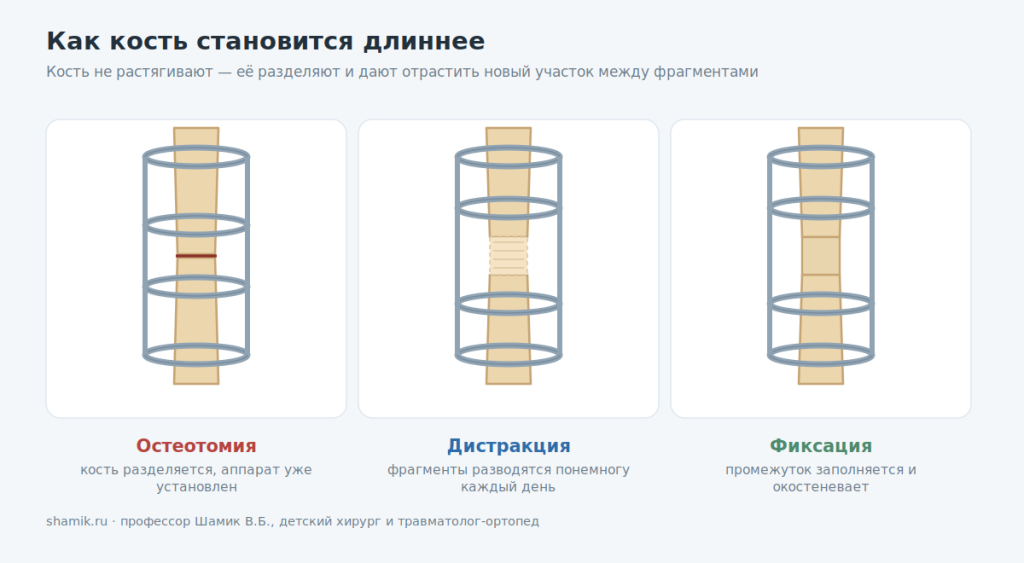 Дистракционный остеогенез: остеотомия, дистракция, фиксация регенерата
