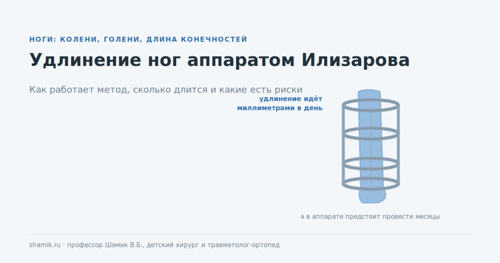Удлинение ног аппаратом Илизарова: кольцевая конструкция на голени