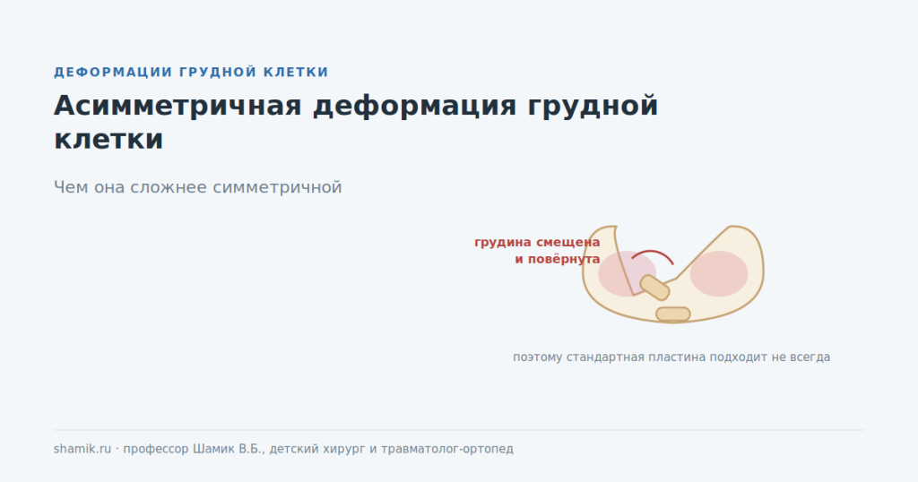 Асимметричная деформация грудной клетки: грудина смещена и повёрнута вокруг оси