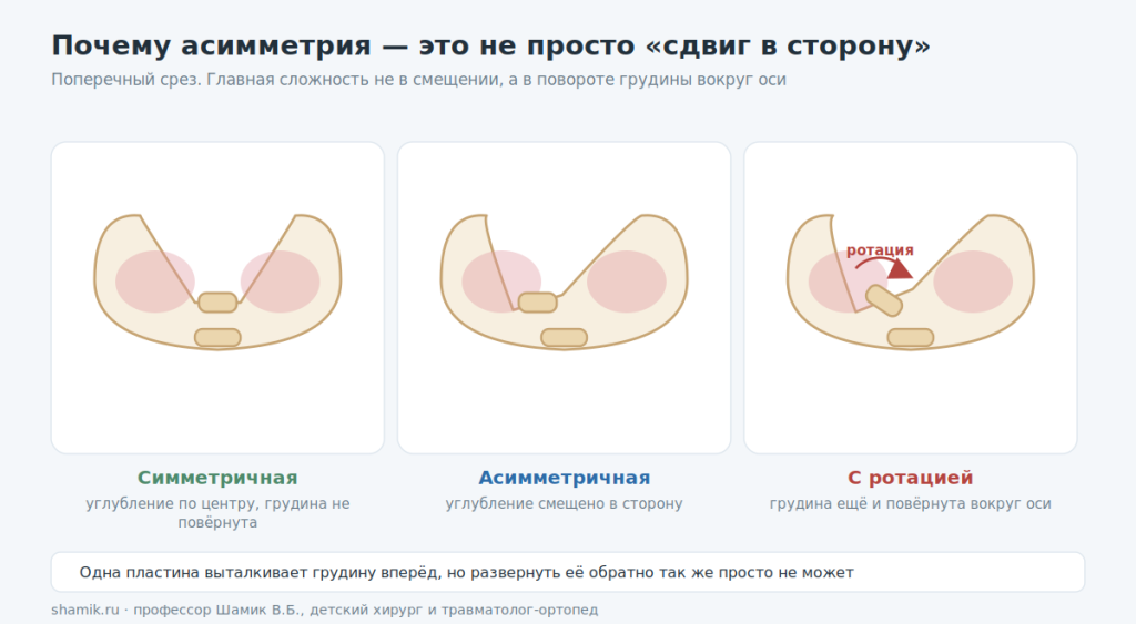 Симметричная, асимметричная и деформация с ротацией грудины на поперечном срезе