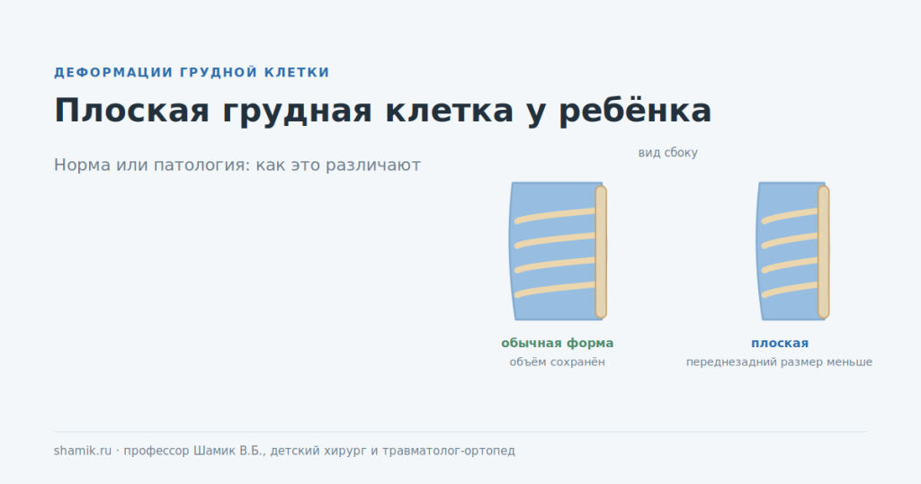 Плоская грудная клетка у ребёнка: сравнение с обычной формой, вид сбоку