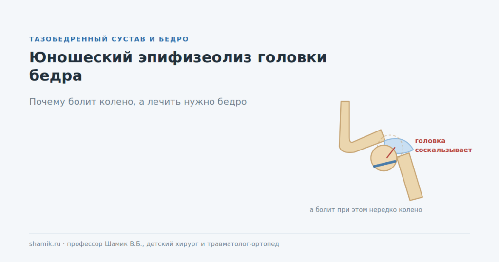 Юношеский эпифизеолиз головки бедренной кости: соскальзывание головки по зоне роста
