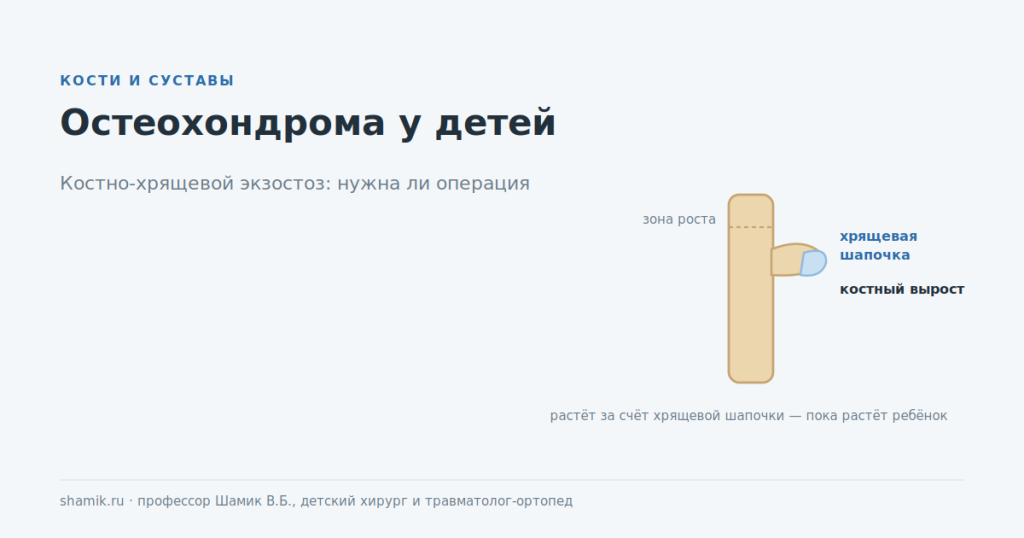 Остеохондрома у детей: костный вырост с хрящевой шапочкой рядом с зоной роста