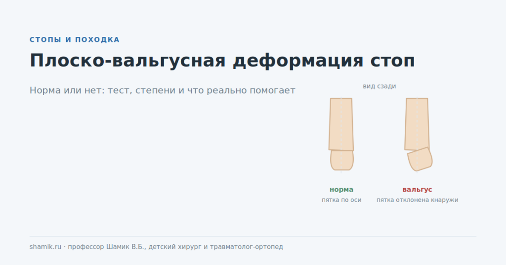 Плоско-вальгусная деформация стоп: отклонение пятки кнаружи, вид сзади
