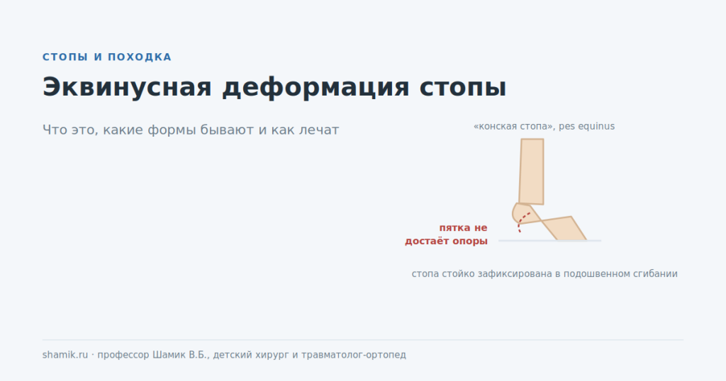 Эквинусная деформация стопы: стопа зафиксирована в подошвенном сгибании