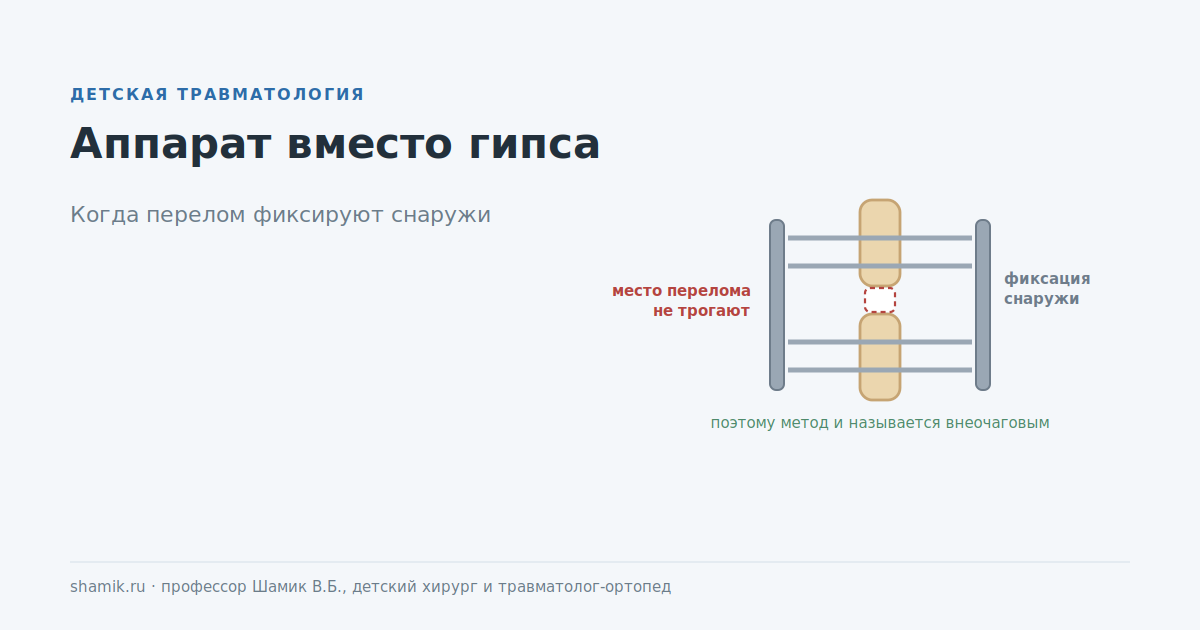 Аппарат при переломе у ребёнка вместо гипса: фиксация снаружи, место перелома не трогают