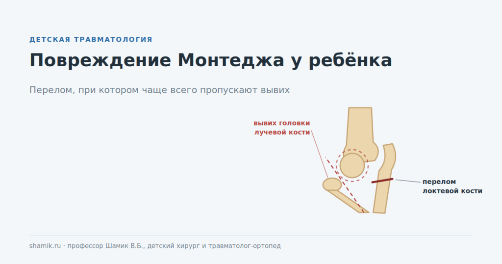 Повреждение Монтеджа у ребёнка: перелом локтевой кости и вывих головки лучевой