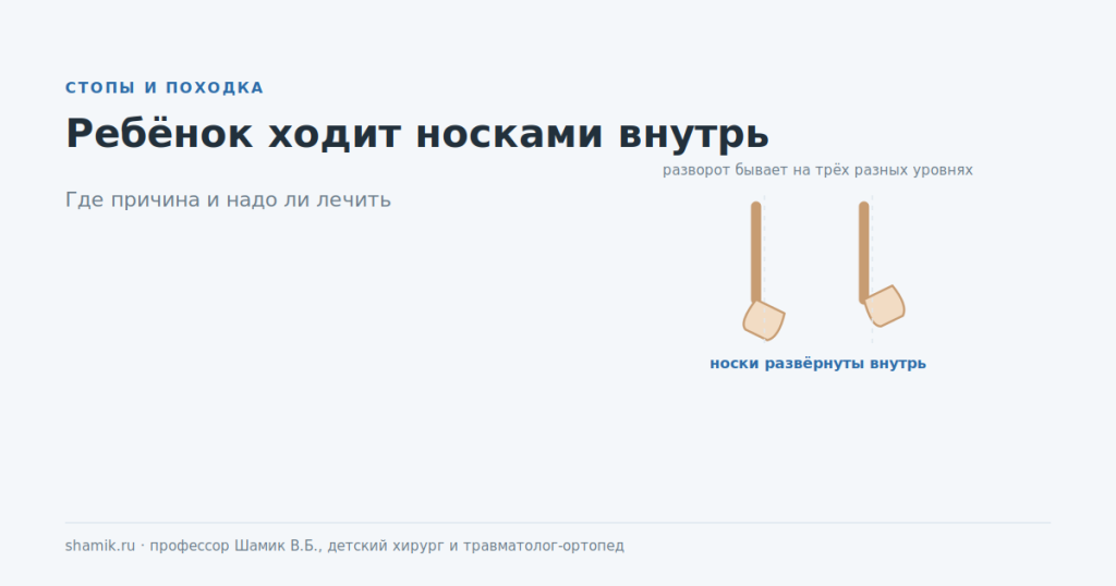 Ребёнок ходит носками внутрь: разворот бывает на трёх разных уровнях