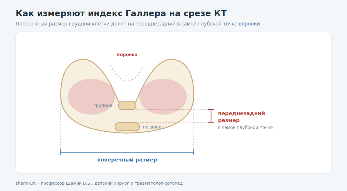 Как измеряют индекс Галлера на срезе КТ: поперечный и переднезадний размеры грудной клетки