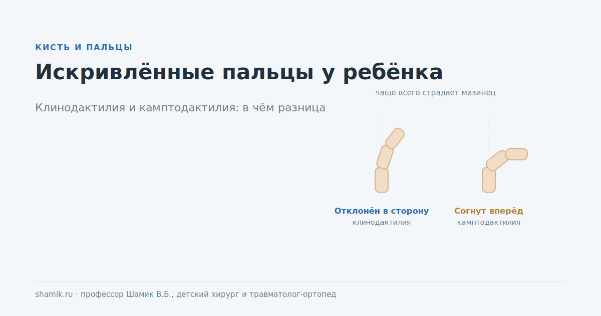 Искривлённые пальцы у ребёнка: клинодактилия и камптодактилия, в чём разница