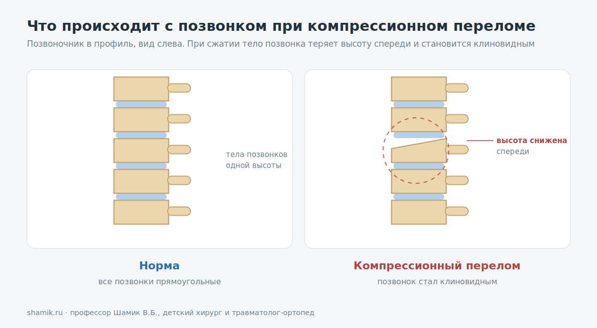 Позвоночник в профиль: норма и компрессионный перелом позвонка у ребёнка