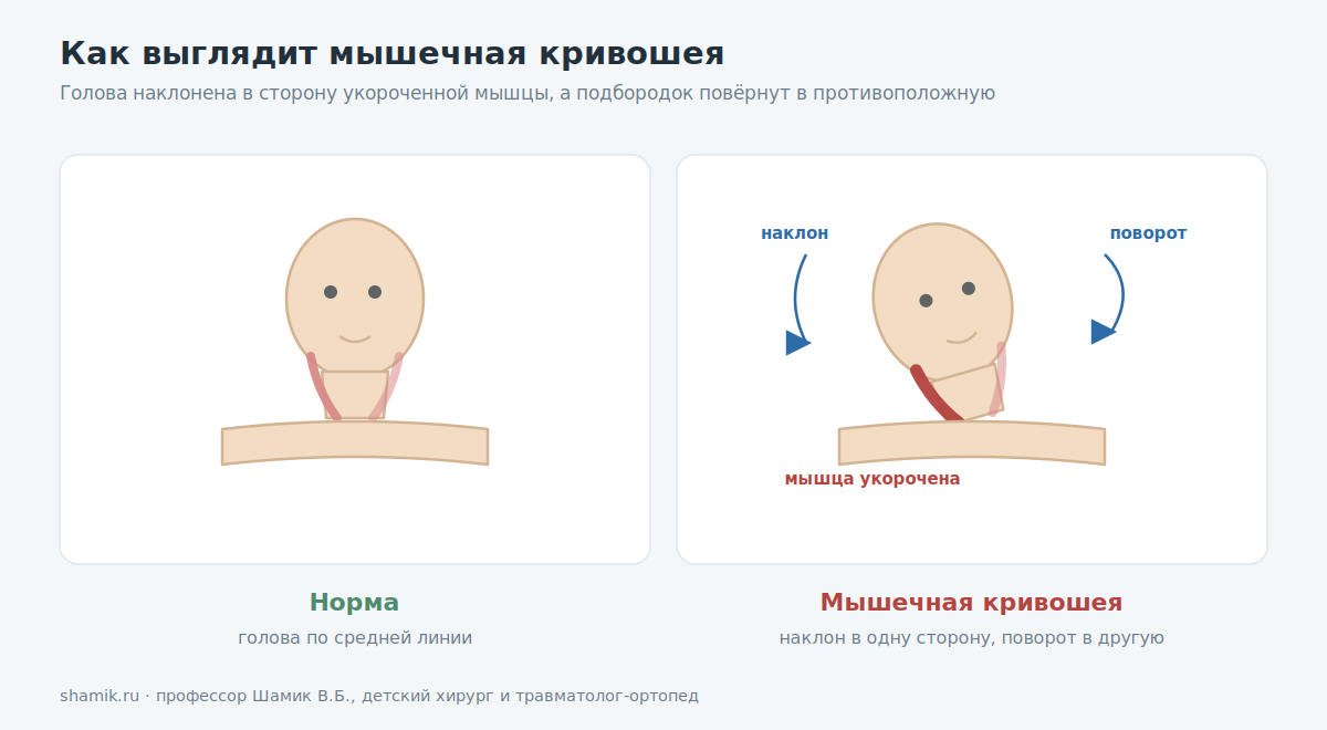 Мышечная кривошея у новорождённых: наклон головы в одну сторону и поворот в другую