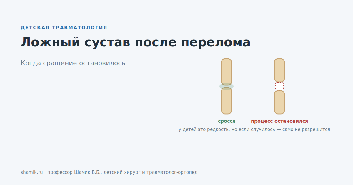 Ложный сустав после перелома у ребёнка: сращение остановилось