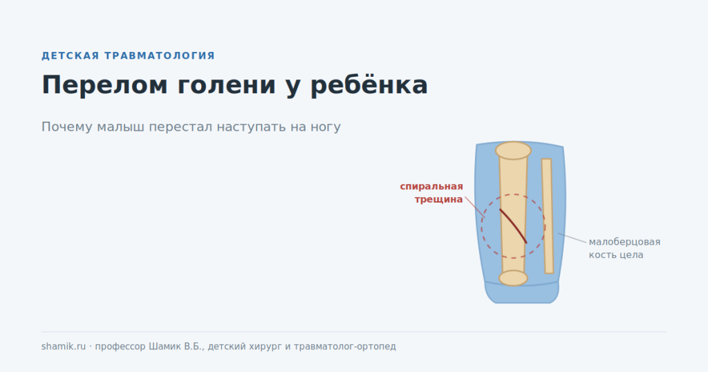 Перелом голени у ребёнка: спиральная трещина большеберцовой кости при целой малоберцовой