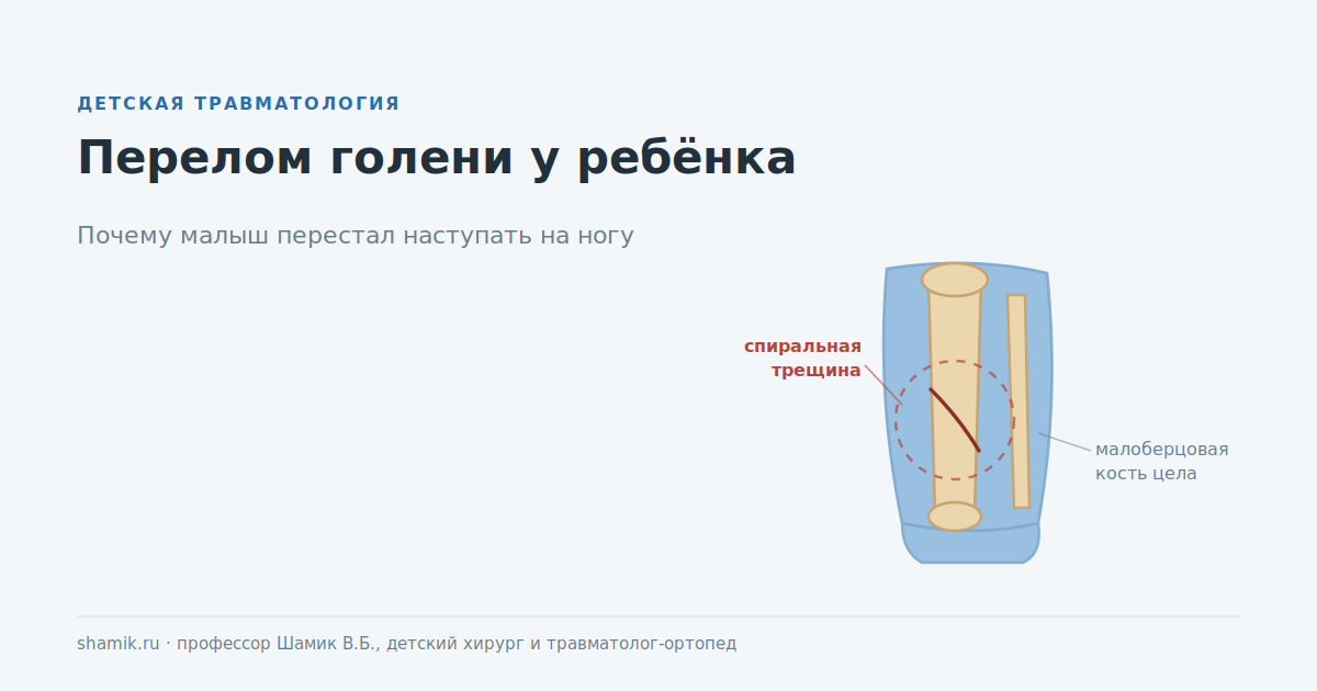 Перелом голени у ребёнка: спиральная трещина большеберцовой кости при целой малоберцовой