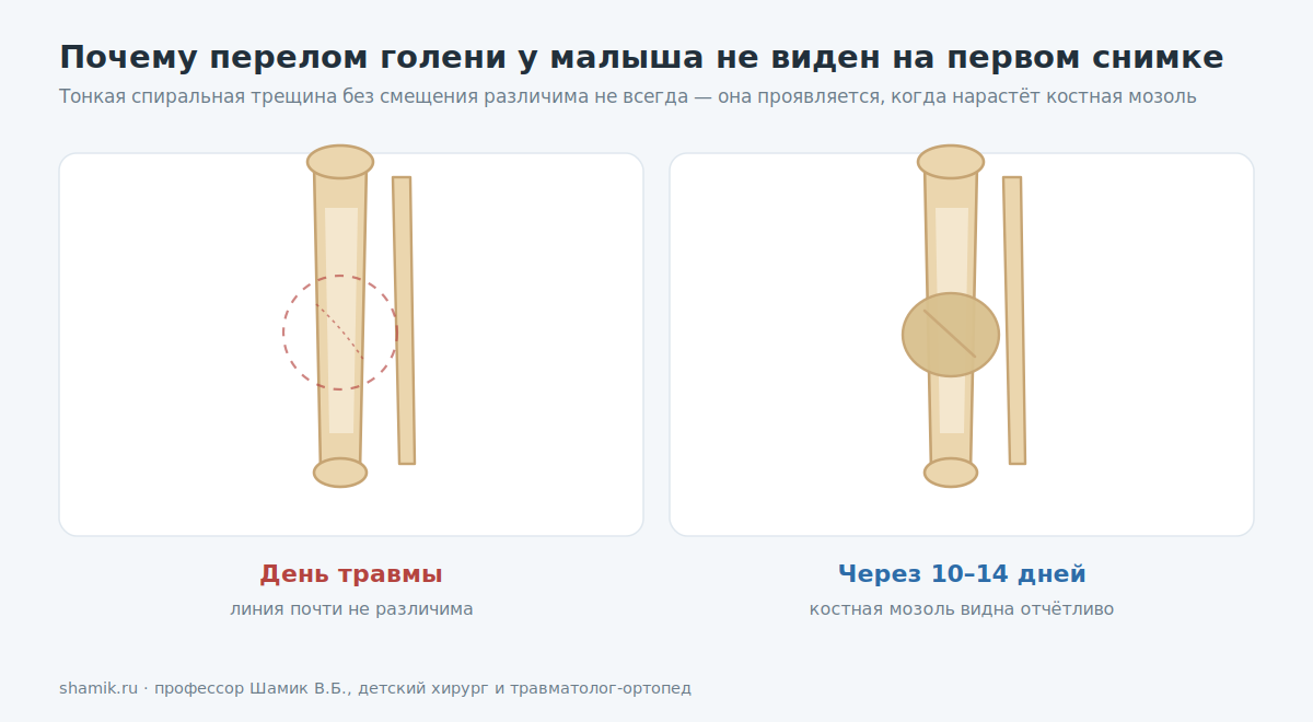 Перелом голени у ребёнка на снимке в день травмы и через две недели, когда видна костная мозоль
