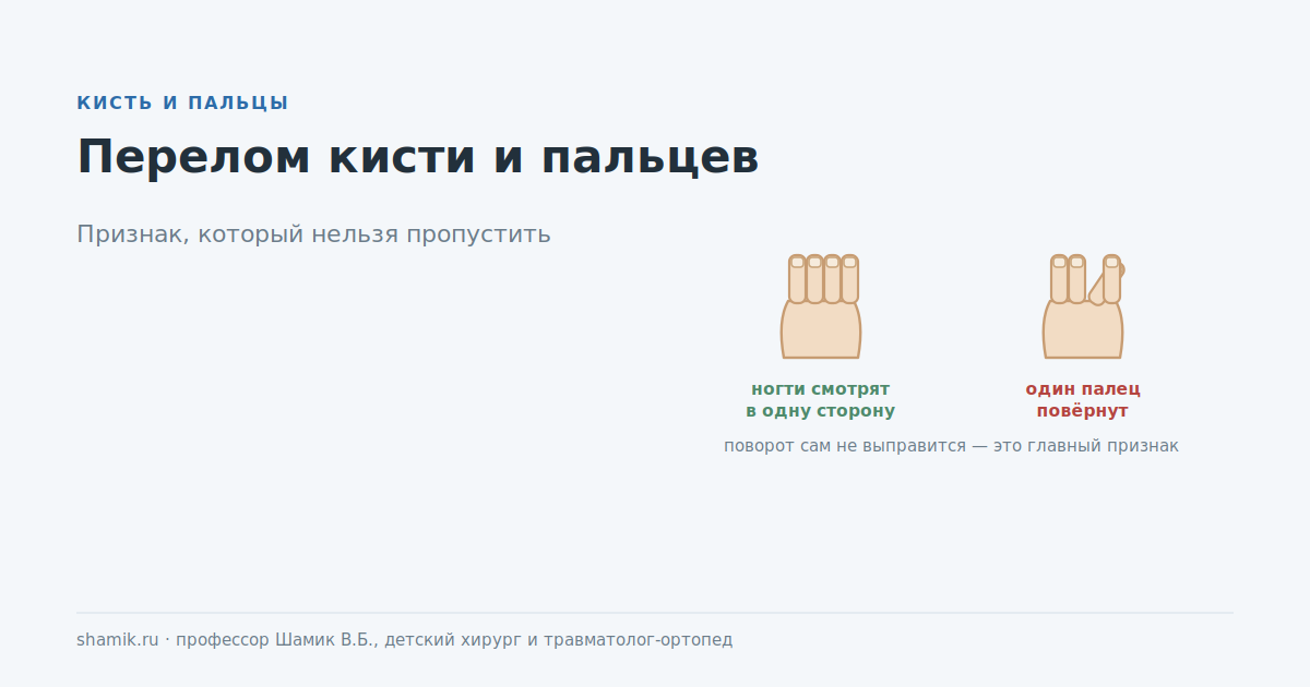 Перелом кисти и пальцев у ребёнка: поворот пальца — главный признак