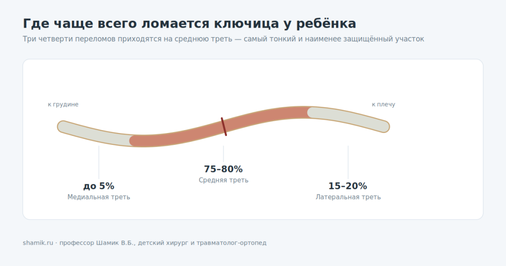 Где чаще всего происходит перелом ключицы у ребёнка: средняя треть, 75–80% случаев
