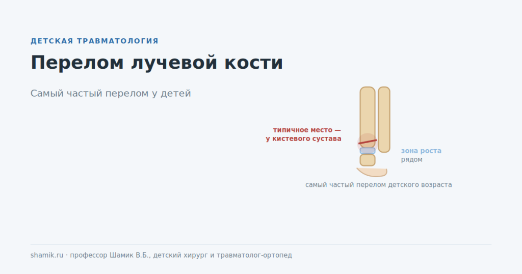 Перелом лучевой кости у ребёнка в типичном месте: у кистевого сустава рядом с зоной роста