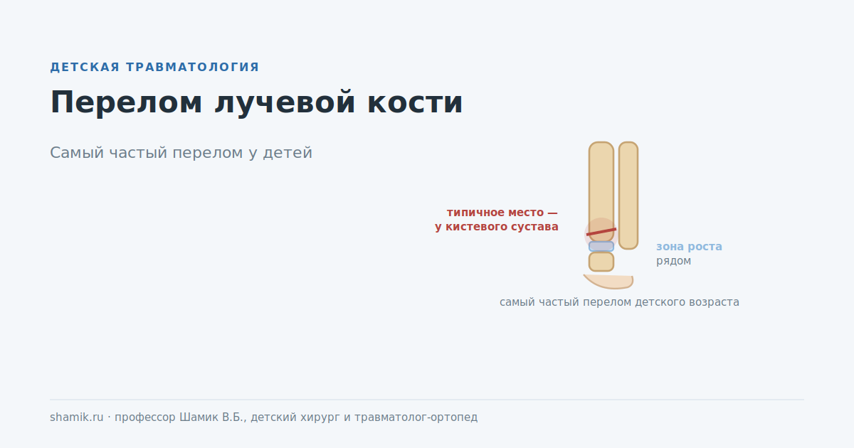 Перелом лучевой кости у ребёнка в типичном месте: у кистевого сустава рядом с зоной роста