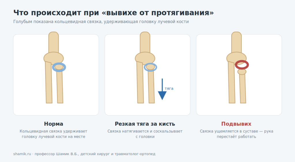 Механизм подвывиха головки лучевой кости: кольцевидная связка соскальзывает при тяге