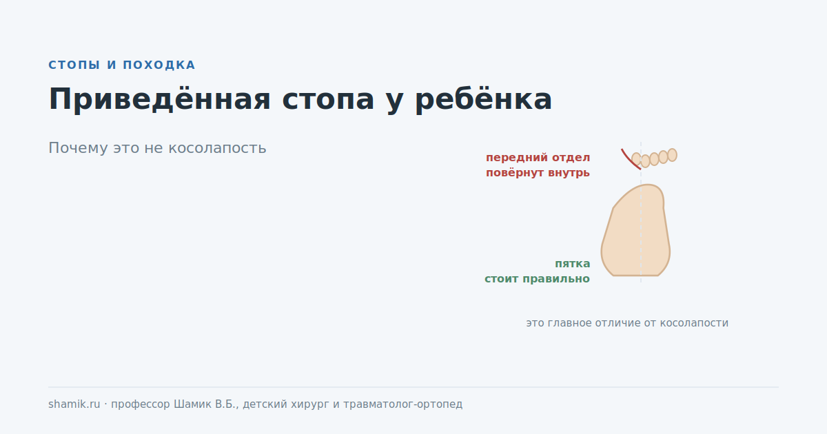 Приведённая стопа у ребёнка: передний отдел повёрнут внутрь, пятка стоит правильно