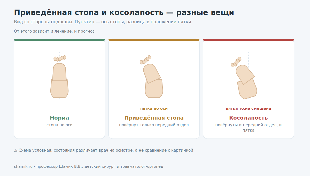 Сравнение нормы, приведённой стопы и косолапости по положению пятки на подошвенном виде