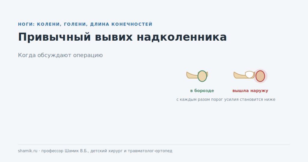 Привычный вывих надколенника: чашечка в борозде и вышедшая наружу