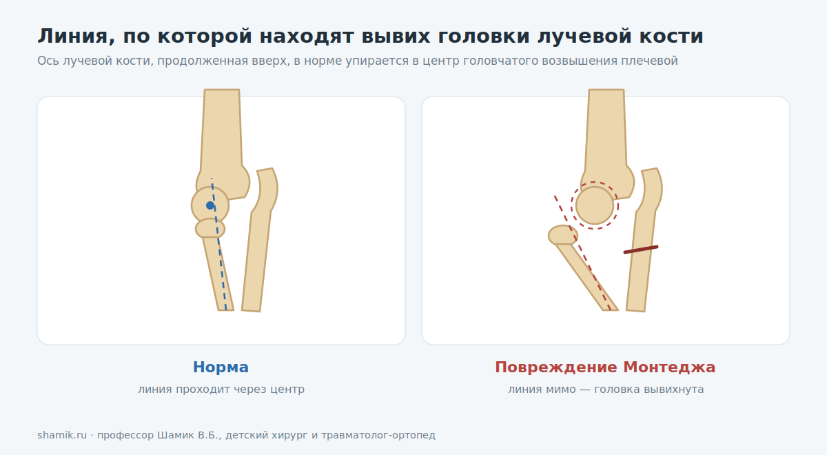 Радиокапитальная линия при повреждении Монтеджа: в норме проходит через центр головчатого возвышения