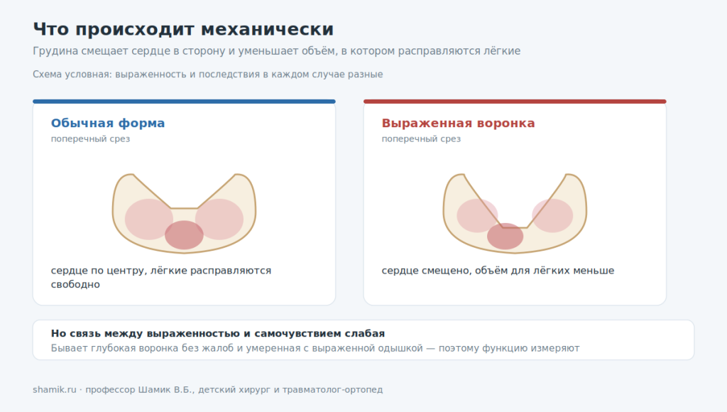 Три этапа ношения корсета при килевидной деформации и количество часов