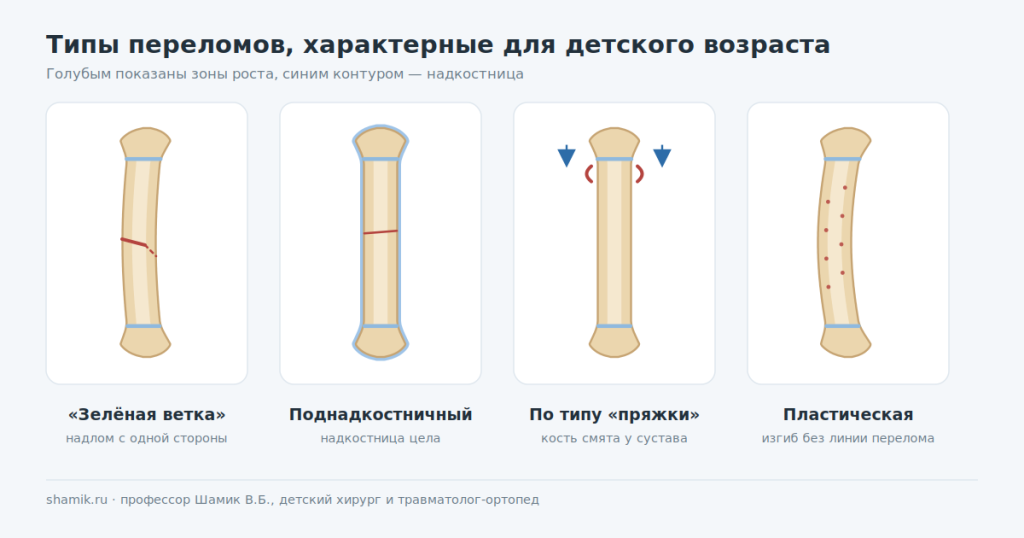 Типы переломов у детей: зелёная ветка, поднадкостничный, по типу пряжки, пластическая деформация