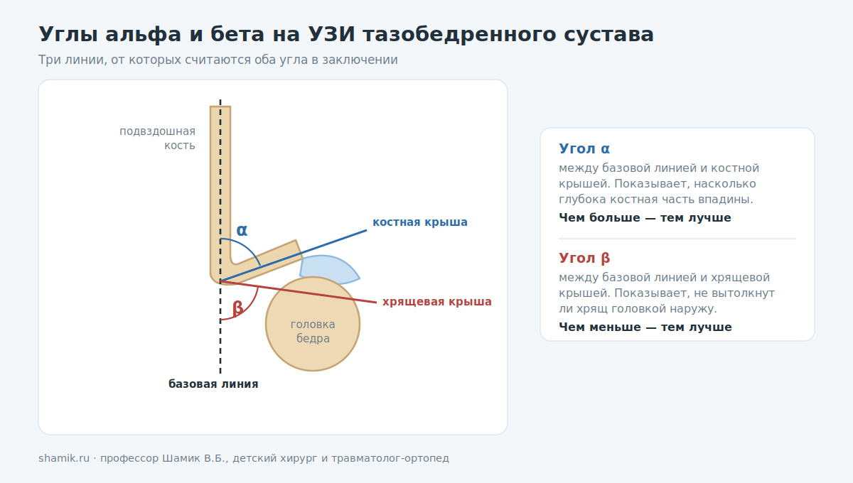 Углы альфа и бета на УЗИ тазобедренного сустава: базовая линия, костная и хрящевая крыша