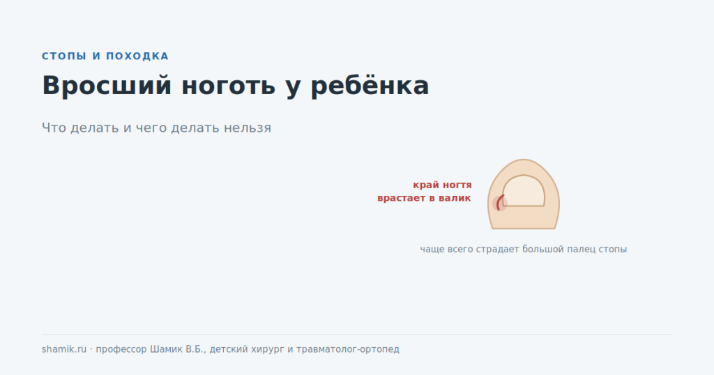 Вросший ноготь у ребёнка: край ногтя врастает в боковой валик большого пальца