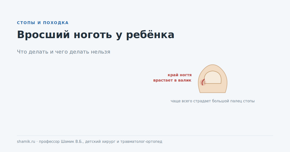 Вросший ноготь у ребёнка: край ногтя врастает в боковой валик большого пальца
