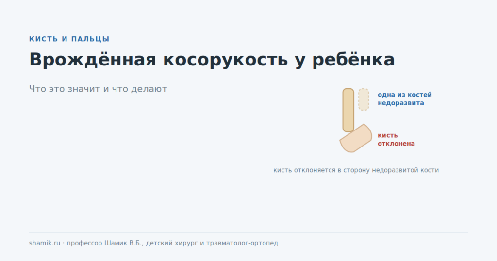 Врождённая косорукость у ребёнка: кисть отклонена в сторону недоразвитой кости предплечья