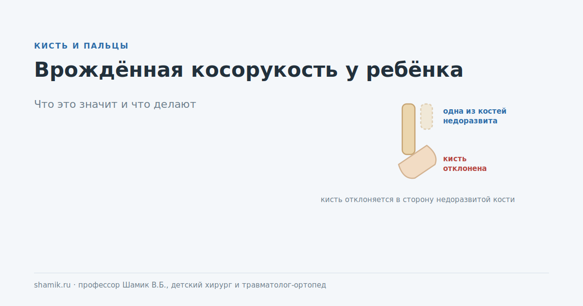 Врождённая косорукость у ребёнка: кисть отклонена в сторону недоразвитой кости предплечья