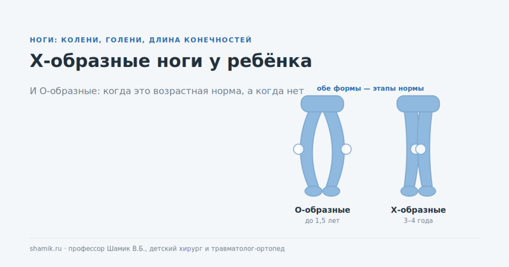 Х-образные и О-образные ноги у ребёнка: две формы оси ног как этапы возрастной нормы
