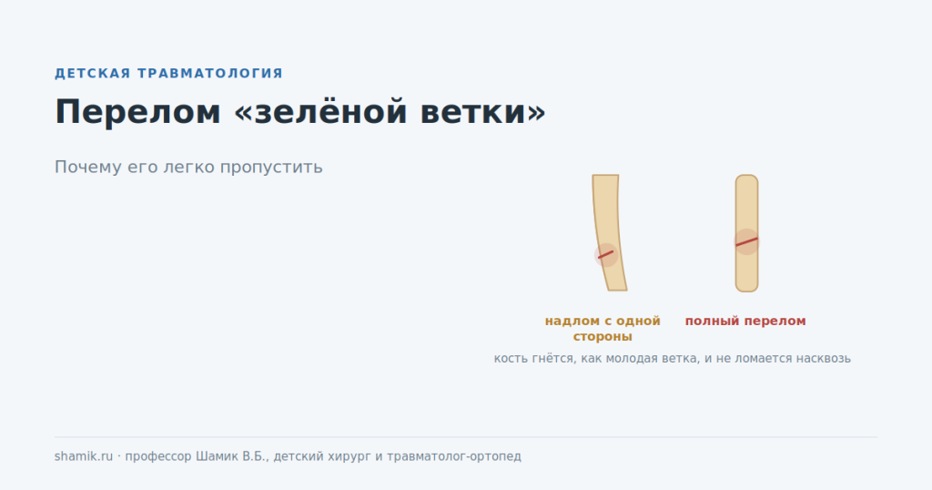 Перелом зелёной ветки у ребёнка: надлом с одной стороны против полного перелома
