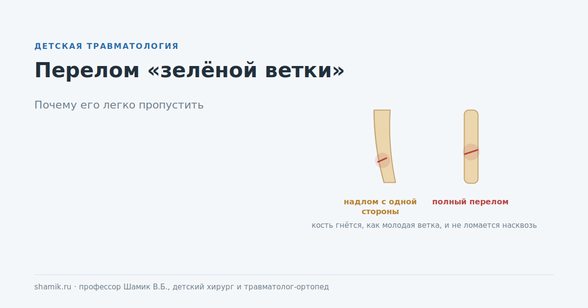 Перелом зелёной ветки у ребёнка: надлом с одной стороны против полного перелома